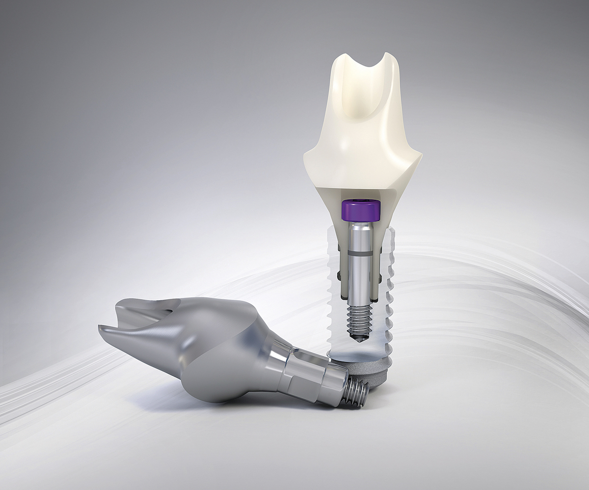 Straumann Implants At Lanta Dente Lanta Dente