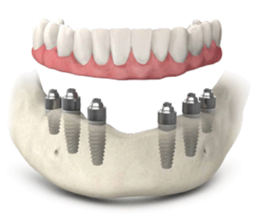 Dental Implants Replacing All of Your Teeth