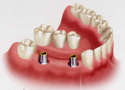 Dental Implants4
