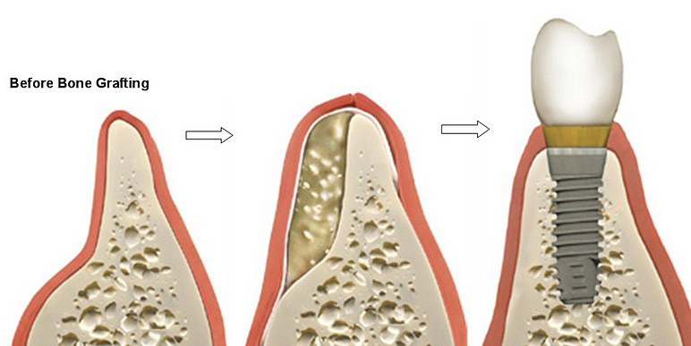 Dental-Implants6