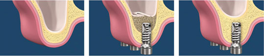 sinus-lift Sinus lift (Sinus Augmentation)